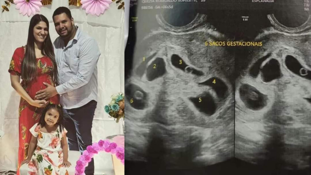 Mãe descobre estar grávida de sêxtuplos durante ultrassom