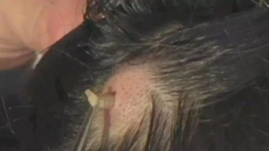 Menina de 4 anos é resgatada com larvas na cabeça: "se alimentando da carne"