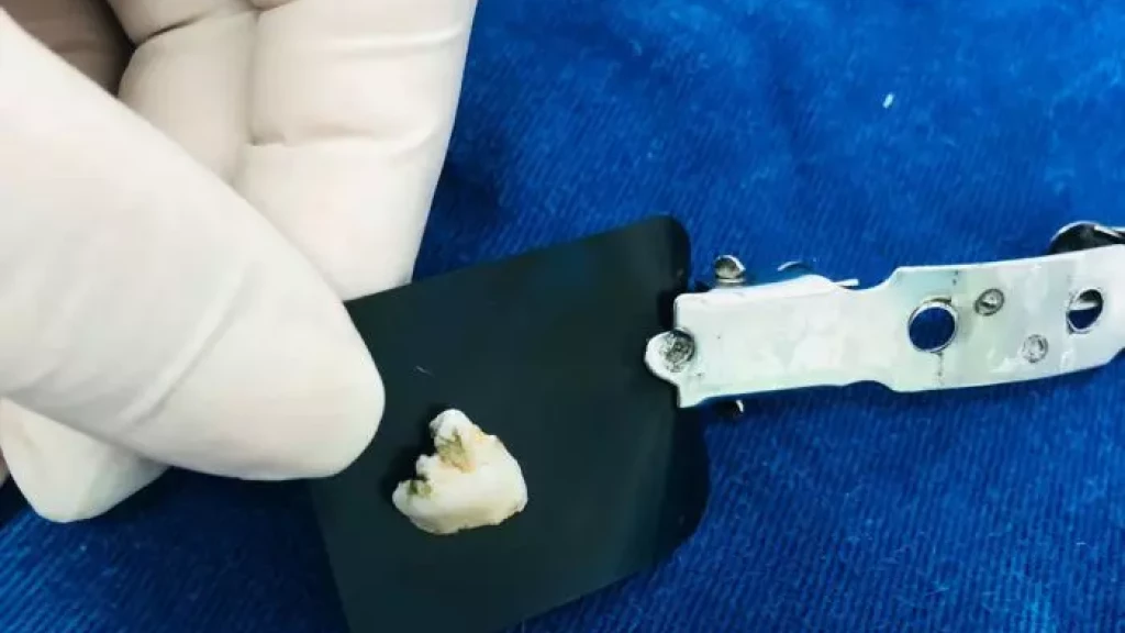 Dente "não humano" é encontrado em marmita de funcionária em Centro de Saúde