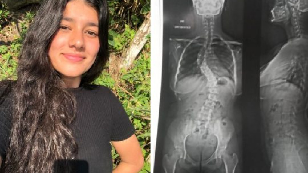 Corrida contra o tempo: Jovem de Porto Belo busca ajuda para cirurgia de coluna