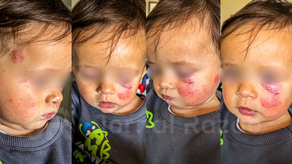 Menino é atacado por bebê em creche: “não foi apenas uma mordida”